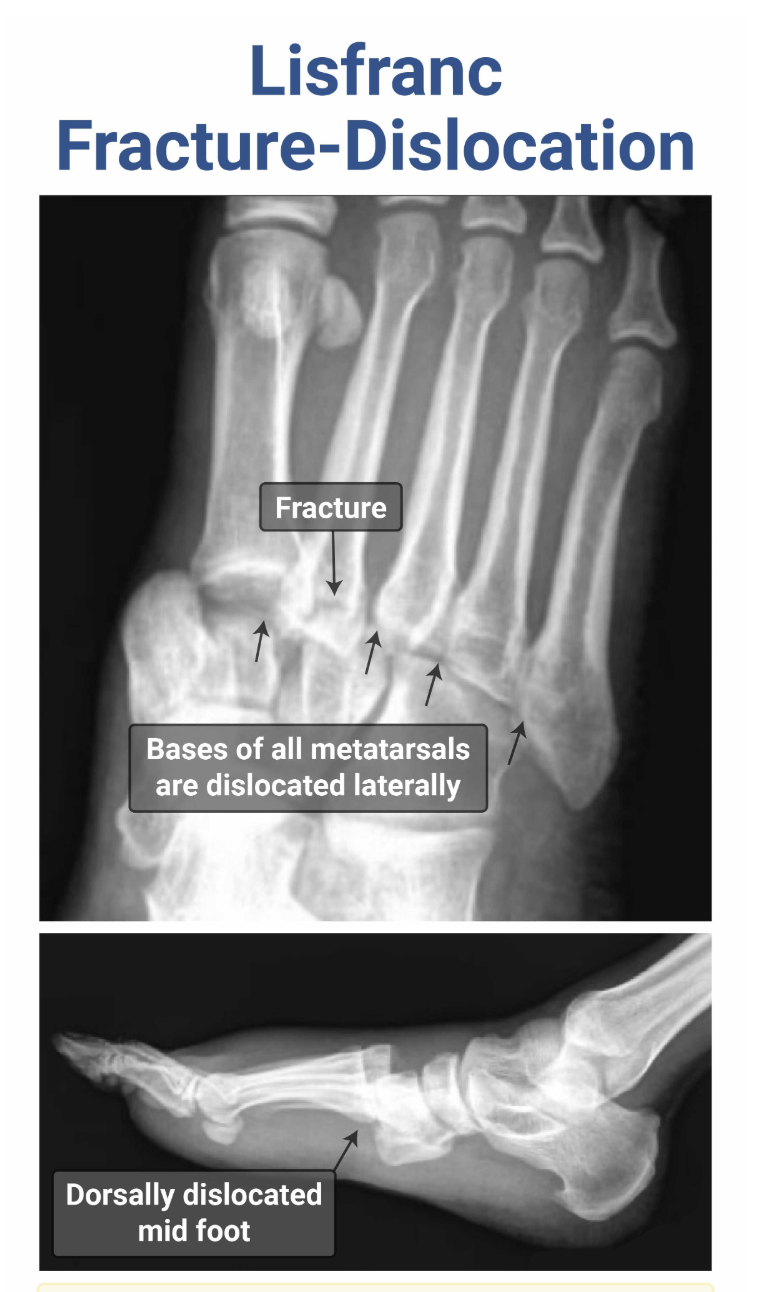 <p>Lisfranc injury = fracture and dislocation of the tarsometatarsal joint, typically due to severe plantar flexion (sports, MVC, fall from heights), resulting in dorsal dislocation (pain is in dorsum of foot), may hear “clicking sound” on rotation of foot. </p><p></p><p>Tx: Immobilization, ortho ORIF</p>