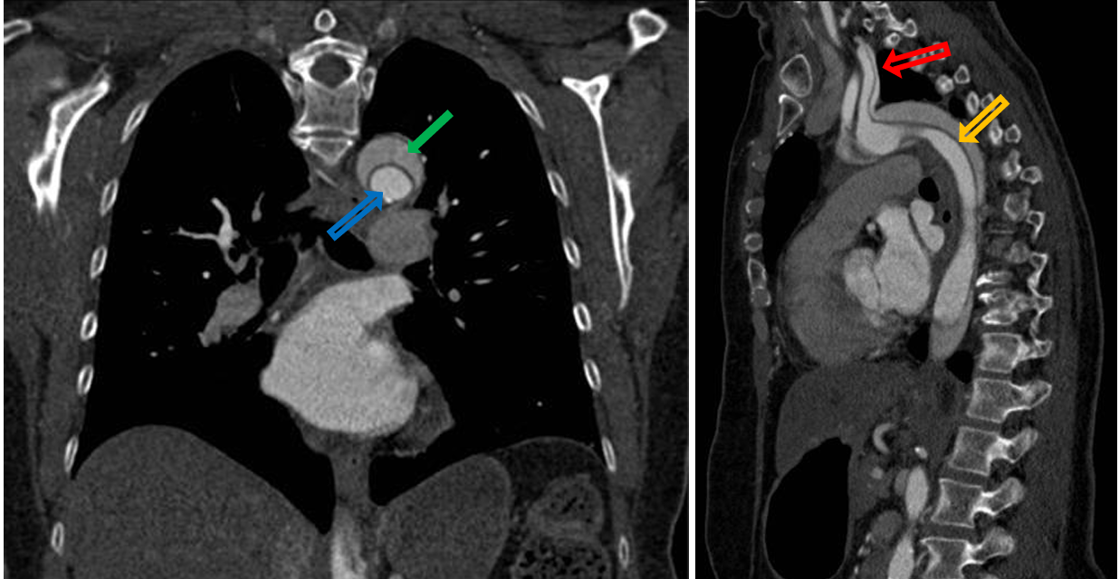 <p>Patient history: sudden severe chest / upper back pain, shortness of breath in a middle-aged patient</p><p>Modality: aortic CT angiography;</p><p>Region: chest; left – coronal view, right – sagittal view, iv. iodine-based contrast agent</p><p>Radiologic sign: Hypodense intima flap (yellow arrow), crescent-shaped false lumen (green arrow), oval true lumen (blue arrow) in the aortic arch and descending aorta. <strong>True lumen is denser due to its higher contrast agent concentration.</strong></p><p>Diagnosis: Stanford A aortic dissection, affecting the left subclavian artery (red arrow)</p>