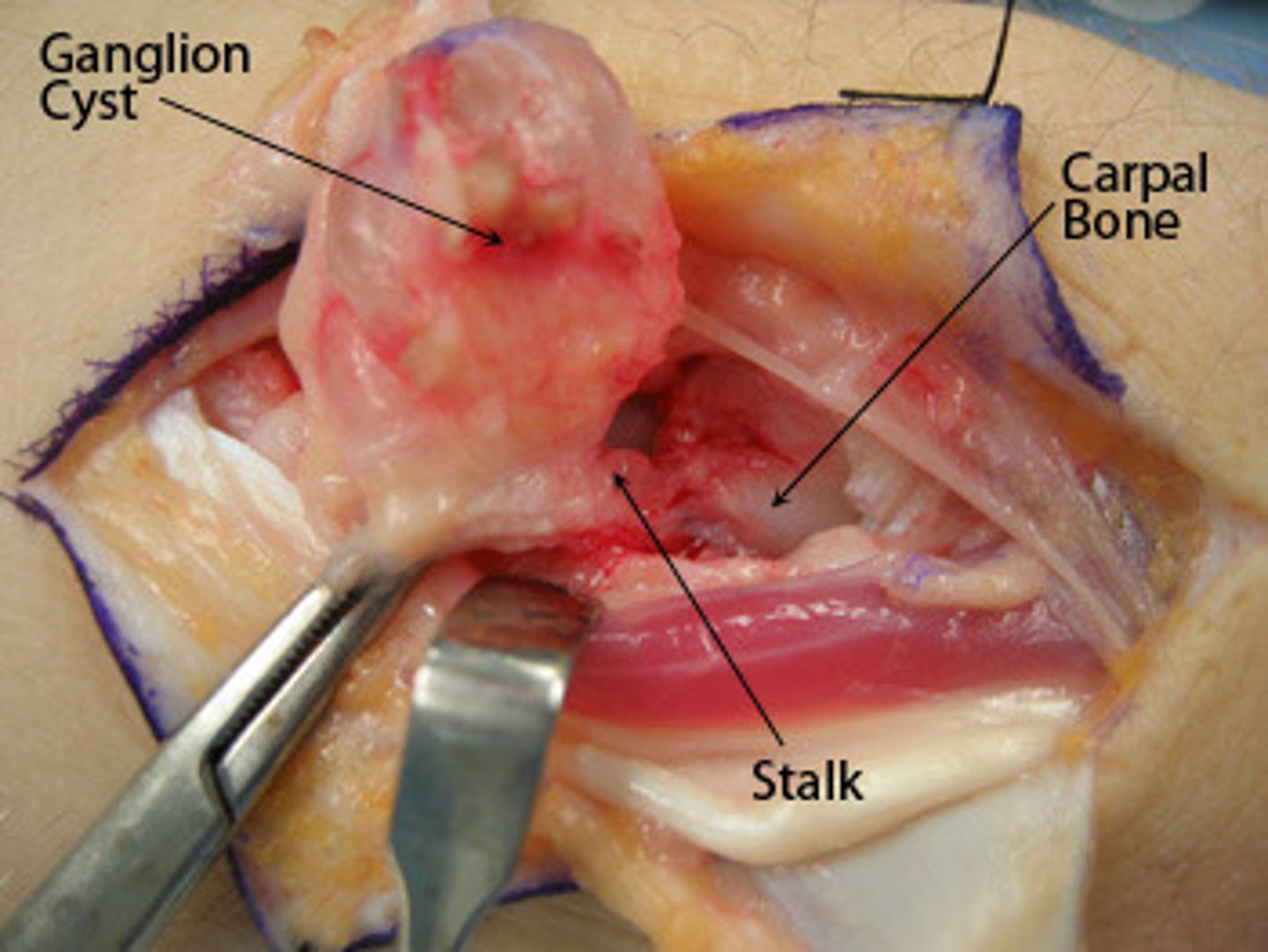<p>excision, surgical removal</p>