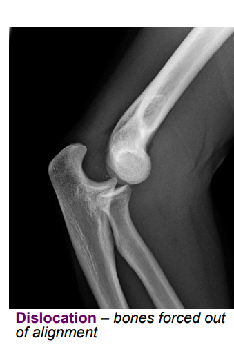 <p>reduction = moving bones back into alignment</p><p></p>