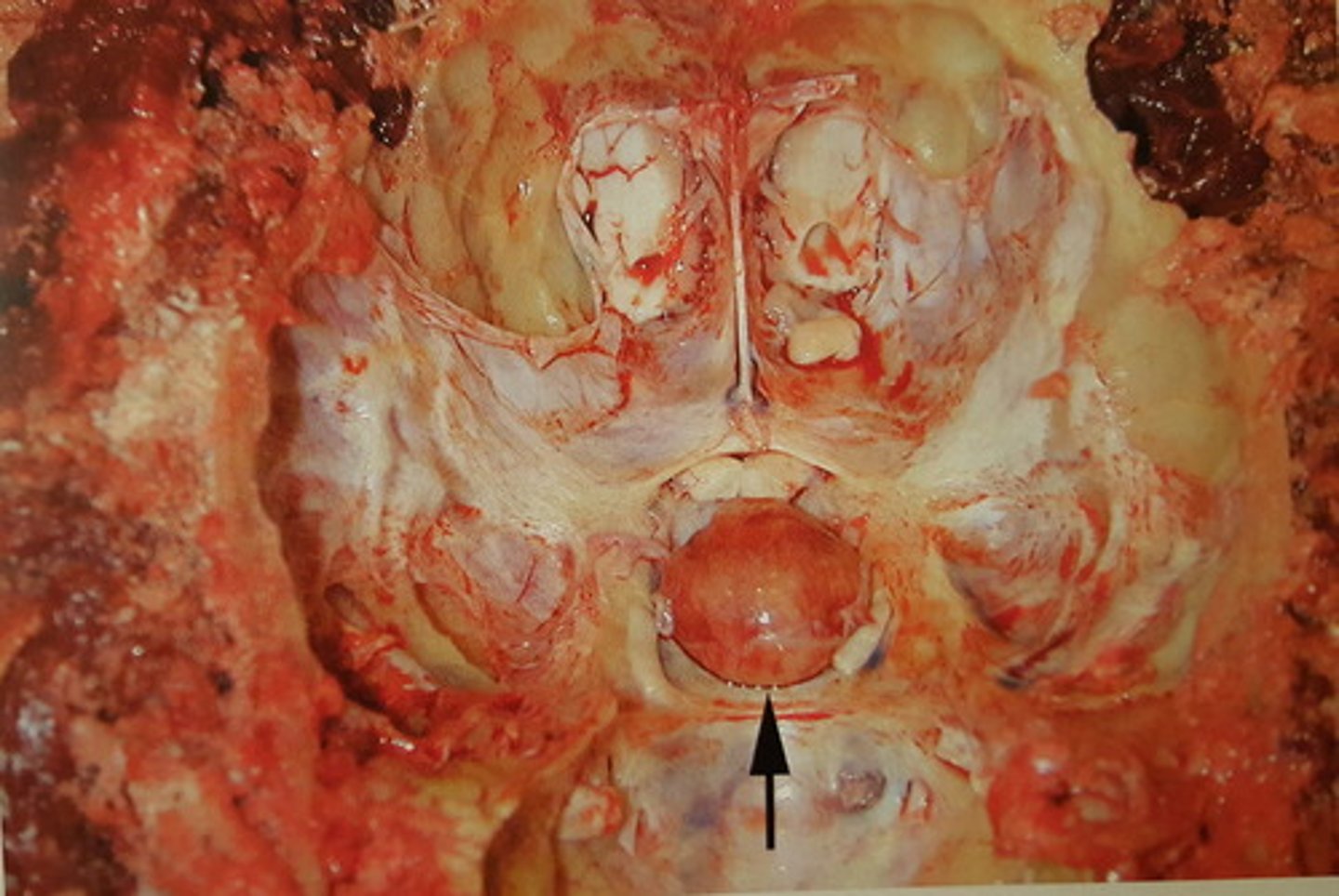<p>Hypofyse fra hest. Patoanatomisk diagnose?</p>