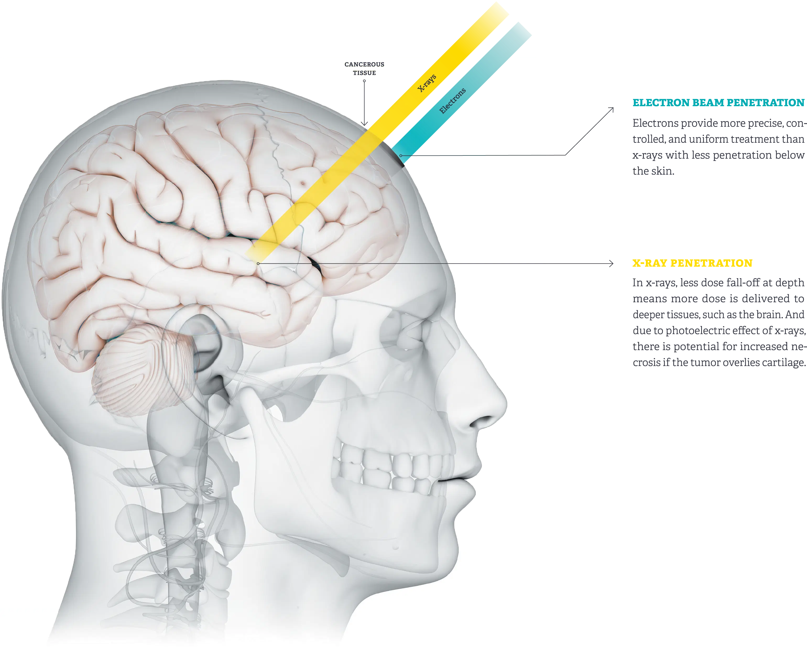 <p>Being able to tx <strong>superficial lesions</strong> with virtually <strong>no dose to underlying tissues</strong></p>