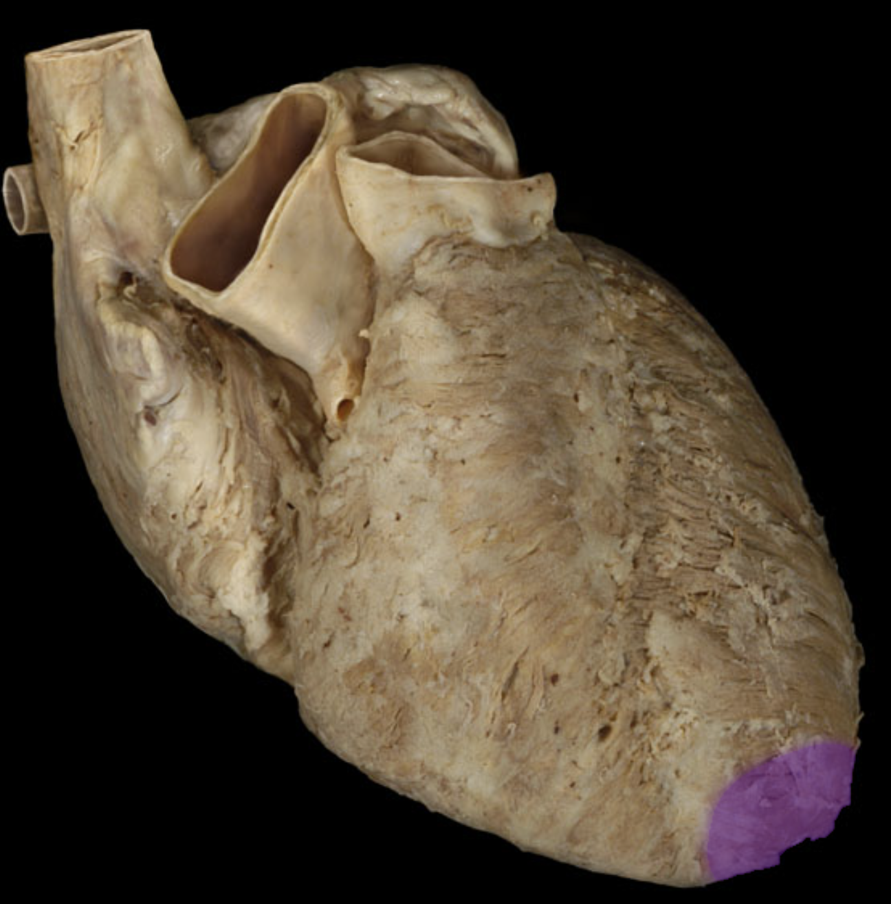 <p>Apex of heart </p>