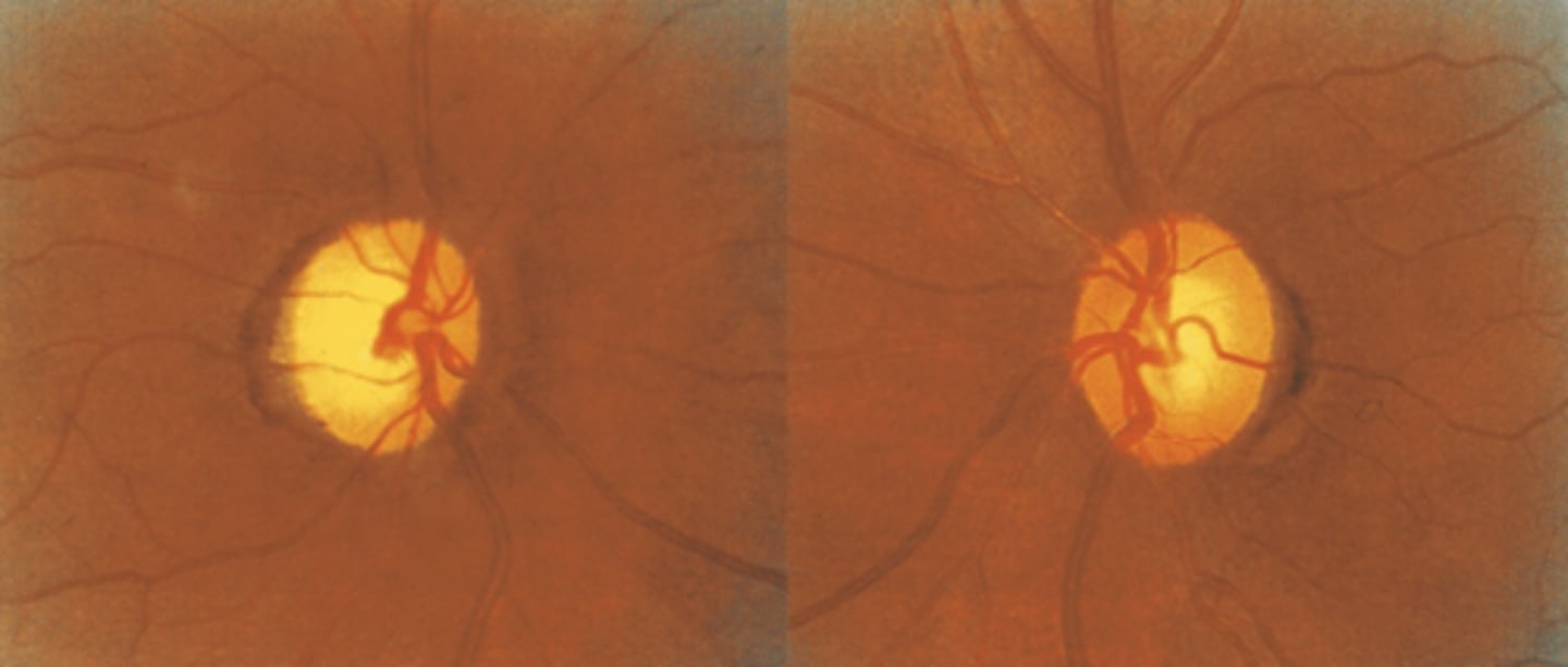 <p>no = rim pallor is most likely neuro disease</p>