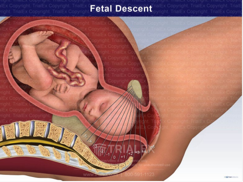 <p><strong>Cardinal Movements: Descent (2)</strong></p><p>-________ of the vertex will occur as fetal _____ passes down into the ______</p><p>-Influenced by shape of maternal pelvis and uterine ____________ strength</p>