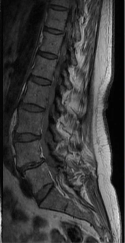 <p>Name the main pathology demonstrated.</p>