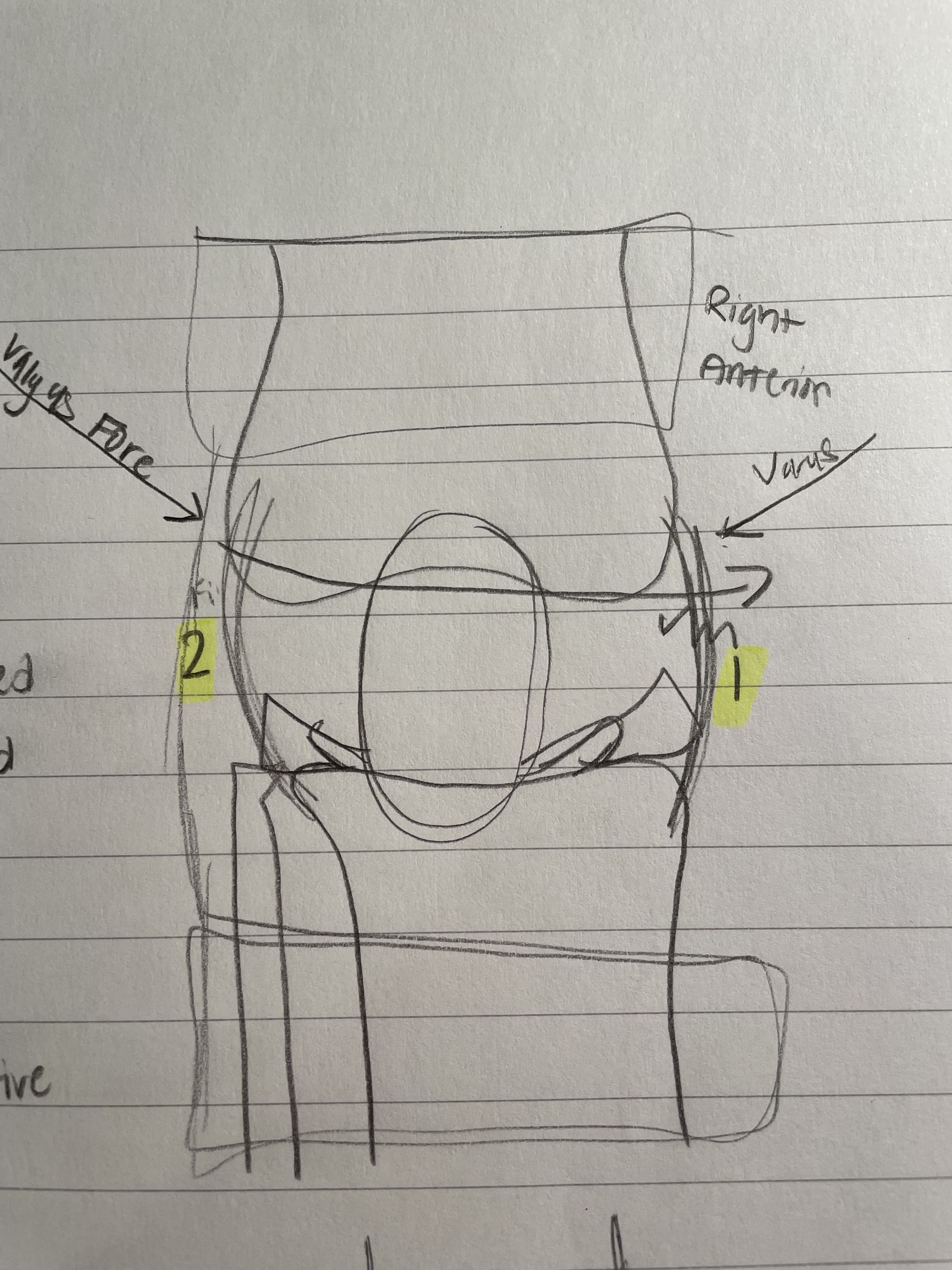 <p>Valgus Force</p>