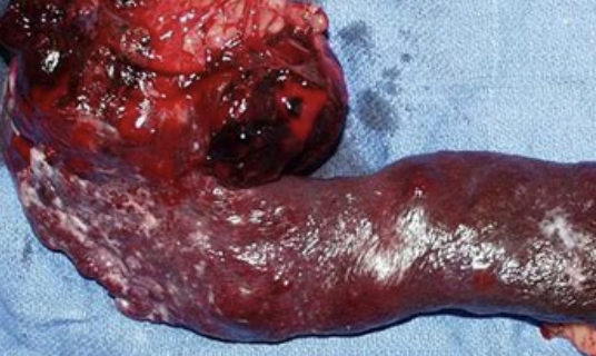<p>visceral forms have high metastatic rates</p>