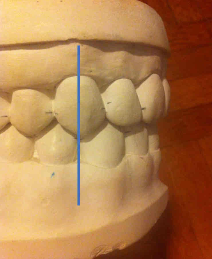 <p>the maxillary canine lies in the embrasure between the mandibular canine and first premolar</p><ul><li><p>the most common occlusion (70% of the population)</p></li><li><p>the mesial slope of the max. canine coincides with distal slope of the man. canine.</p></li></ul>