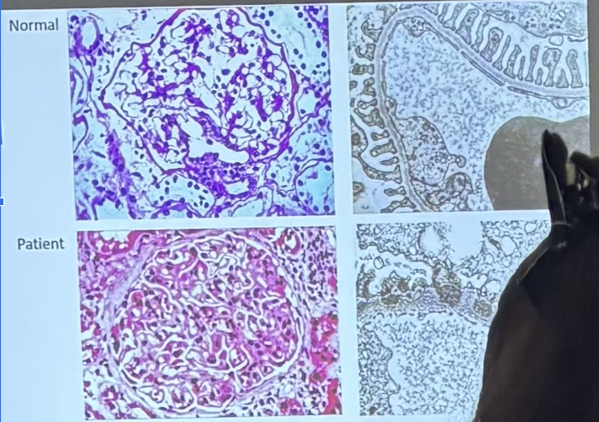 <p><span style="background-color: transparent;"><span>What type of GN is this? How do you know?</span></span></p><p><span style="background-color: transparent;"><span>a. Acute proliferative GN</span></span></p><p><span style="background-color: transparent;"><span>b. Membranous nephropathy</span></span></p><p><span style="background-color: transparent;"><span>c. Minimal change disease</span></span></p><p><span style="background-color: transparent;"><span>d. Rapidly progressive GN</span></span></p>