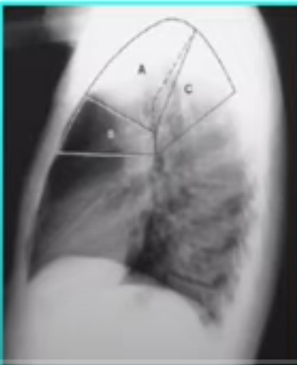 <p>Apicar, desde la primera costilla posterior hasta la cisura menor</p>