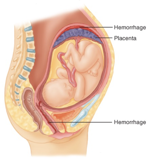 <p>Abruptio placenta </p>
