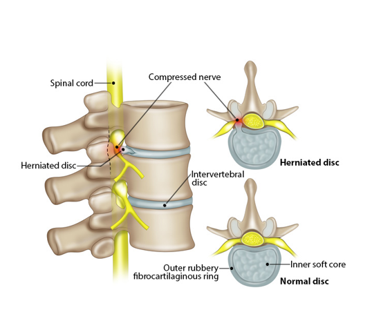 <p>-reside between the vertebrae to provide cushioning</p><p>-2 parts: *Anulus fibrosis *Nucleus pulposus</p>