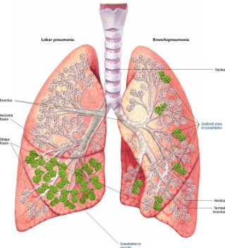 <p>alveolar pneumonia (aka lobar or pneumococcal pneumonia)<br><br>bronchopneumonia<br><br>interstitial pneumonia</p>