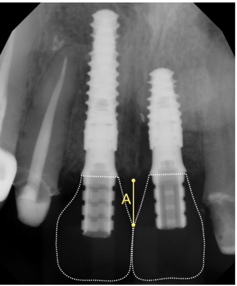 <p>The radiograph is showing provisional implant restorations of #8 and 9. Which is the most preferable length to achieve papilla fill with current provisional tooth shape regarding the length (A) from crestal bone to contact point between #8 and 9 ? (Select one)</p><p>5 mm</p><p>3 mm</p><p>4 mm</p><p>6 mm</p>