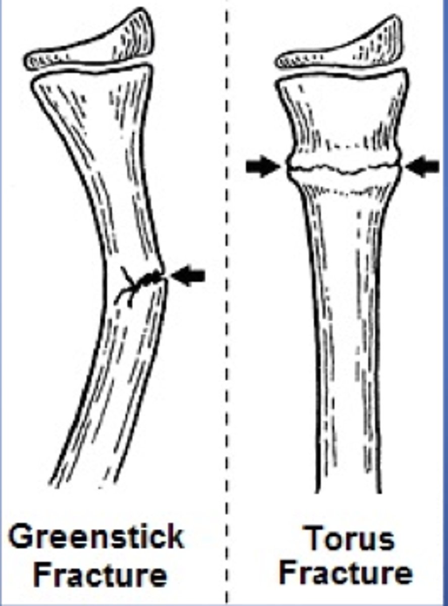 <p>principles of paediatric fractures</p><p>aim : avoid growth disturbance</p><p>periosteum : thicker - rapid healing</p><p>types: torus, buckle</p><p>classification: salter harris</p>