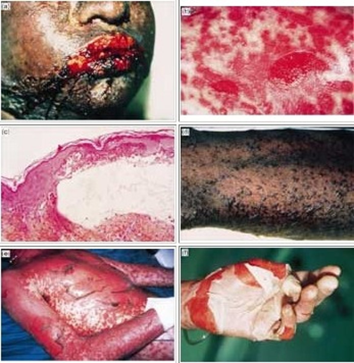 <p>dx: SJS (if &gt;30% = TEN)</p><p>tx: treat like severe burn- admit to burn unit, pain control, withdrawal of offending meds, fluid &amp; electrolyte replacement, wound care</p><p>+ Nikolsky sign is when rubbing of skin exfoliates the outer layer</p>