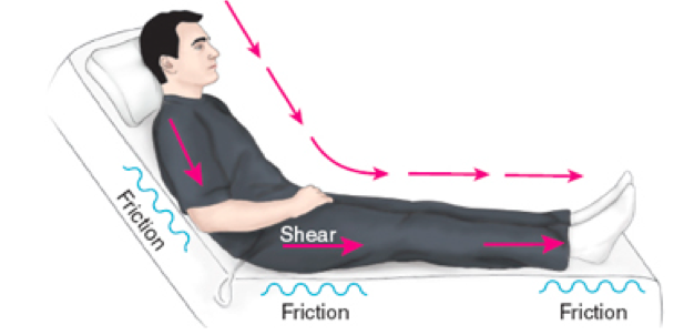 <p>exerting a parallel force on patient’s body </p><ul><li><p>deeper tissue (e.g., muscles)</p></li></ul><p></p>