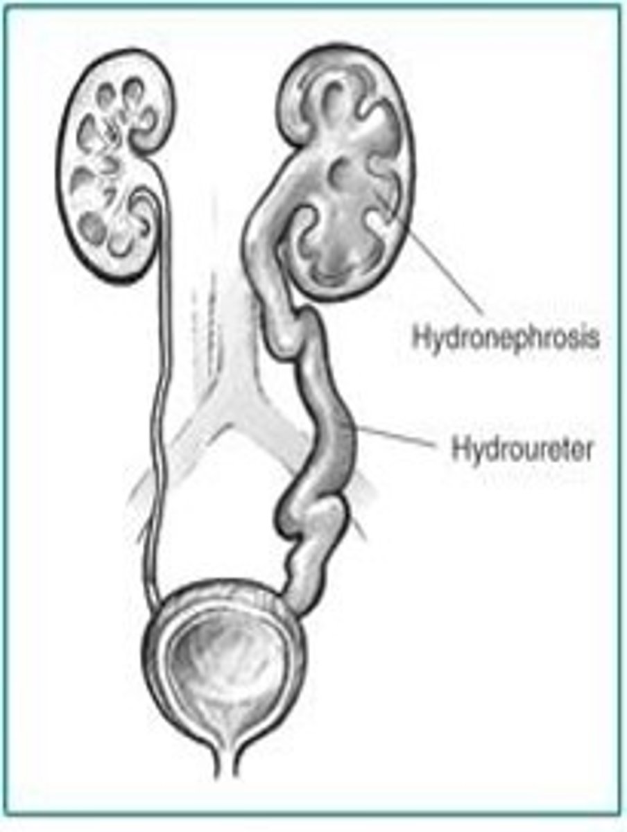 <p>Unilateral, hydroureter, hydronephrosis</p>