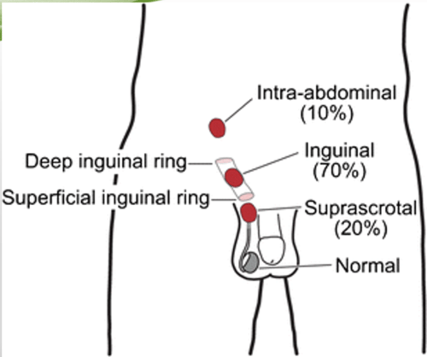 <p>inguinal canal</p>