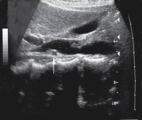 <p><span><span>The arrow is demonstrating which of the following vascular structures?</span></span></p>