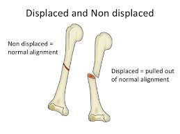 <ul><li><p>when the bone has broken and the broken ENDS are NO LONGER ALIGNED</p></li><li><p>it has been “displaced”</p></li><li><p>misalignment </p></li></ul><p></p>