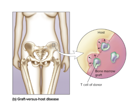 <p>Graft versus host disease</p>
