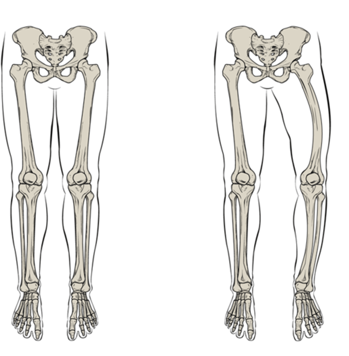 <p>A disease of unknown origin that is characterized by extensive breakdown of bone tissue followed by abnormal bone formation</p>