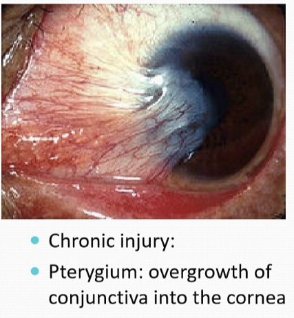 <p>Pterygium: overgrowth of conjunctiva into the cornea </p>