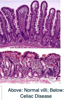 <ul><li><p>In <strong>celiac disease</strong>, immune reaction to gluten causes <strong>loss of the microvilli brush border</strong></p></li><li><p>Leads to <strong>malabsorption</strong> in the intestines</p></li></ul><p></p>