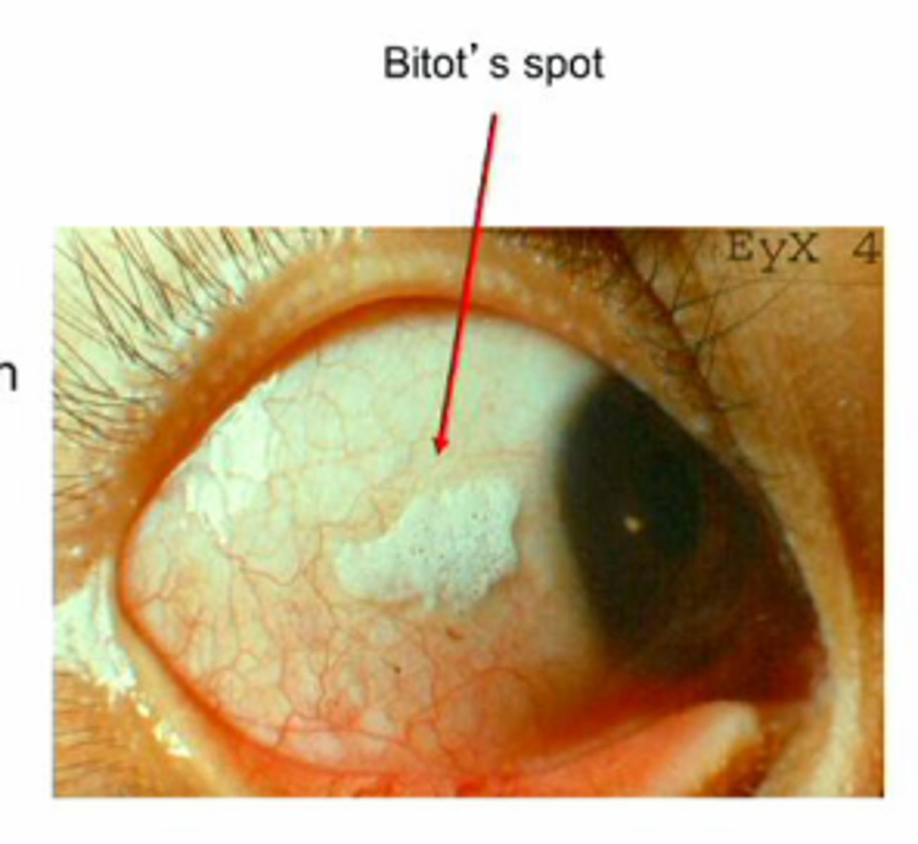 <p>1) Xerophthalmia (dry eye from inadequate mucus production)</p><p>2) Bitot's Spots (leading cause of preventable blindness in children)</p><p>3) Night Blindness (nyctalopia)</p><p>4) Xerosis (itching, burning of eyelid)</p><p>5) Decreased immune system (increased risk for infections)</p><p>6) Follicular hyperkeratosis (replace mucus-secreting cells in respiratory, gastrointestinal & urinary tracts with keratinizing cells)</p>