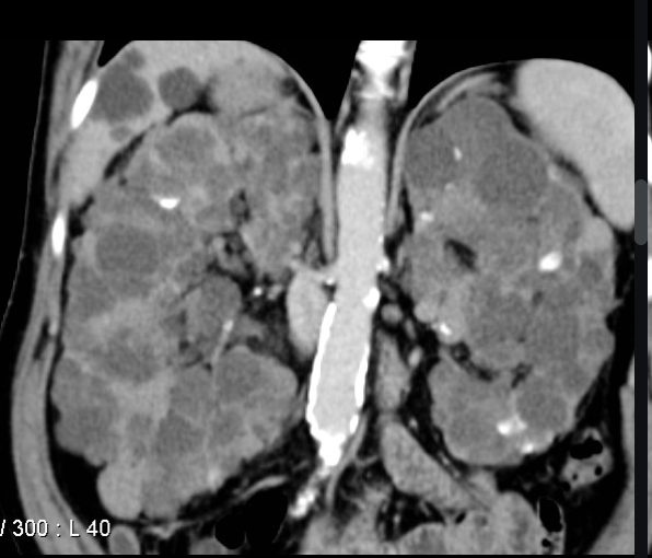 <p>21 y/o female presents to the ED for bilateral<strong><u> 10/10 flank pain</u></strong>. She states that she thinks her mom had a kidney problem, but she doesn’t know what it is. Vitals are stable with the exception of <strong><u>150/95</u></strong>. On physical exam you note a mid systolic click and hepatomegaly. Labs reveal <strong><u>hematuria</u></strong>, polycythemia vera, high phosphorus and uric acid, low vitamin D, sodium, calcium. See CT scan. What is your treatment plan?</p>