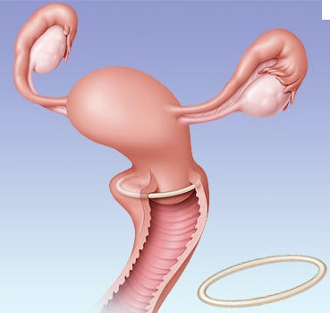<p>Inserted into the vagina where it slowly releases hormones and prevents ovulation. 94-99% effective. DOESNT PROTECT FROM STI.</p>