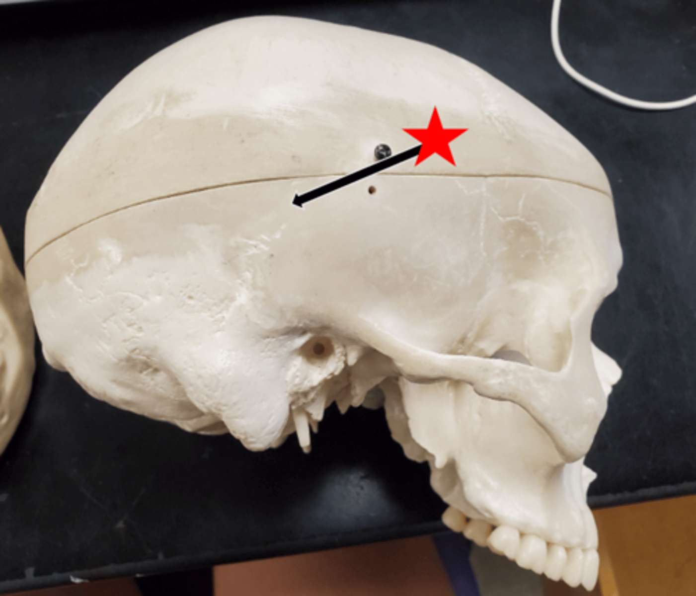 <p>What suture is the arrow pointing to in the image?</p>