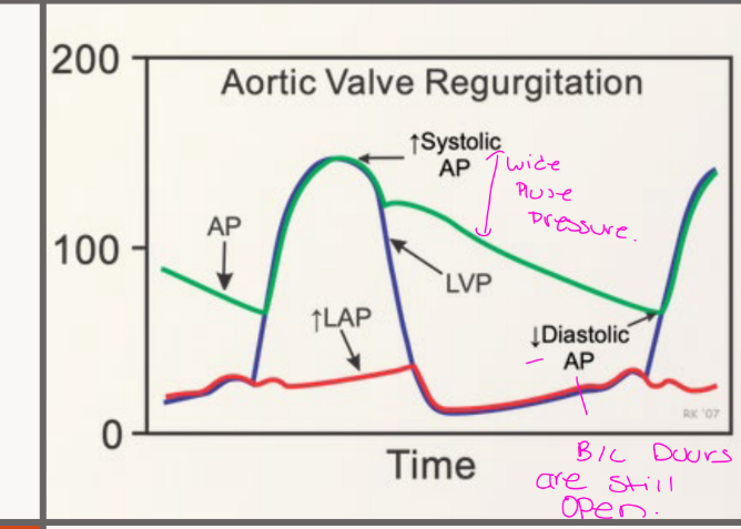 <p>Changes in the aortic</p><p>pressure, LVP and LAP</p><p>can be observed with</p><p>aortic regurgitation</p>