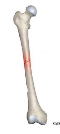 <p>what type of fracture is this?</p>