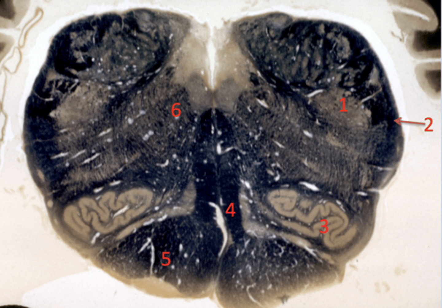 <p>spinal trigeminal tract</p>