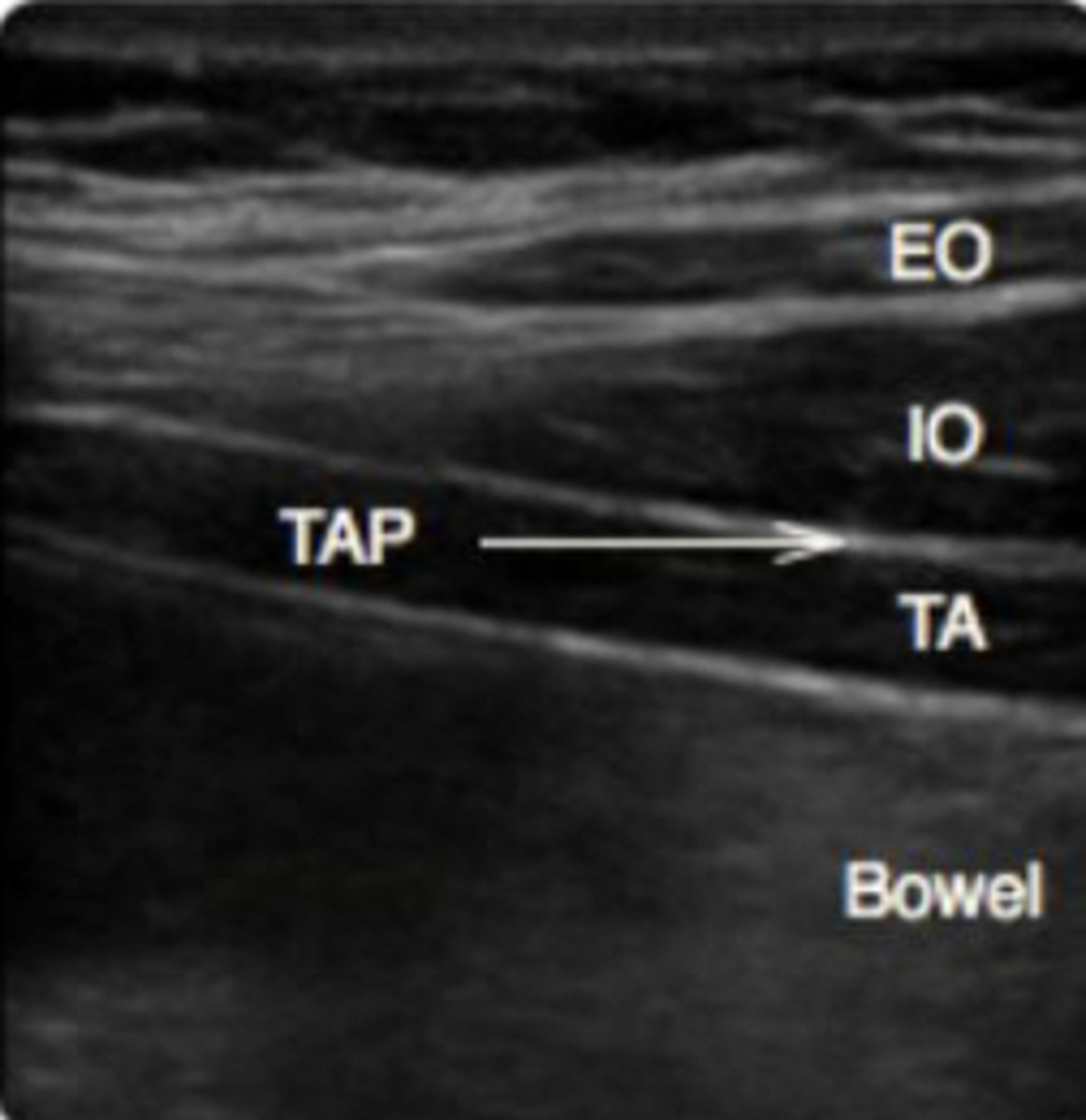 <p>Superficial to deep:</p><p>-Subq tissue</p><p>-External oblique m</p><p>-internal oblique m</p><p>-transverse abdominis m</p><p>-peritoneum</p>