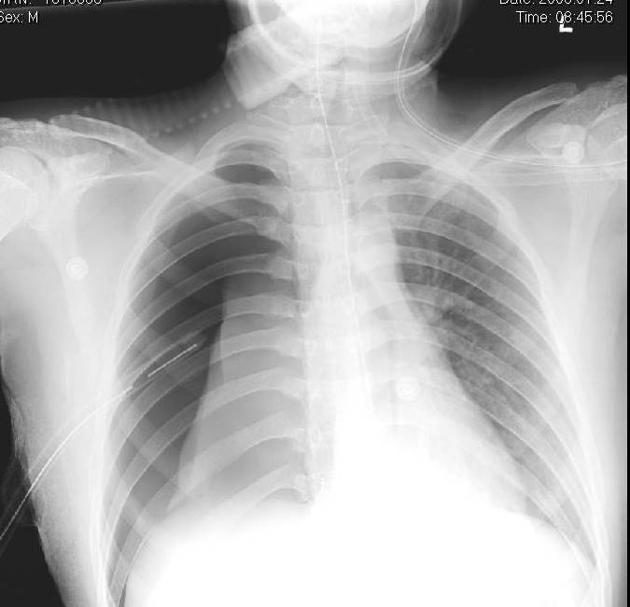 <p>Describe the abnormality demonstrated on this supine CXR.</p>