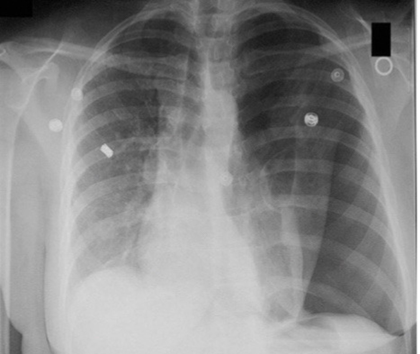 <p>Tension pneumothorax</p>
