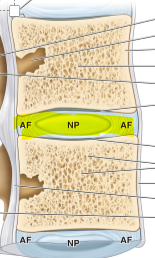 <p>between the spinal bones and its called herniated disk. </p>