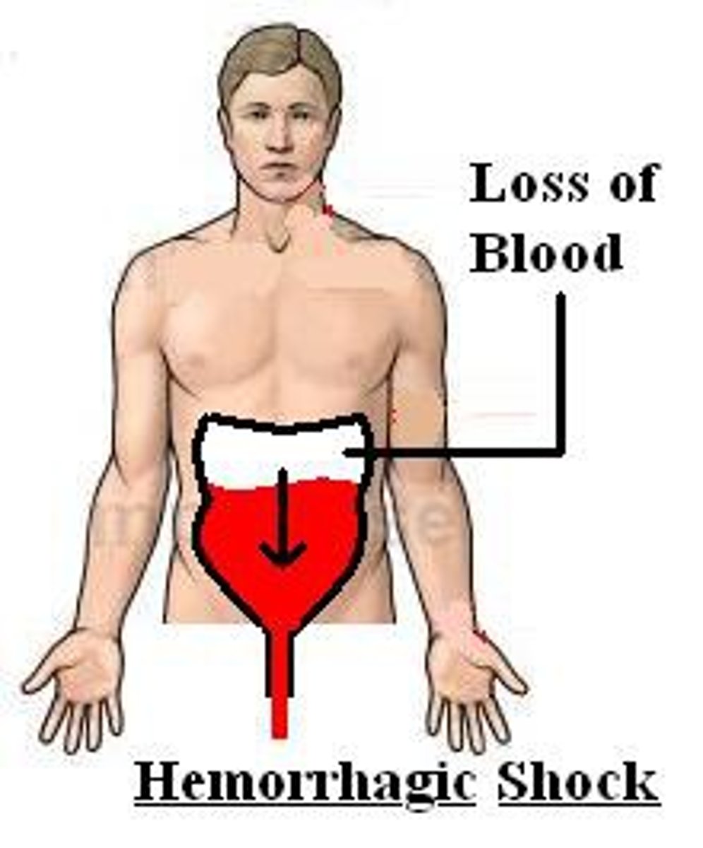<p>drop in bp <90 systolic</p>