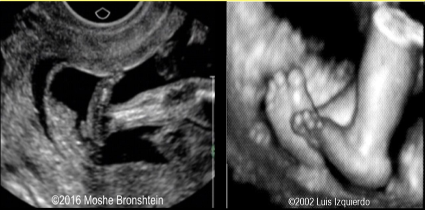 <p>what pedal abn is assoc w/trisomy 13 + 18</p><p>a) talipes equinovarus</p><p>b) polydactyly</p><p>c) club foot</p><p>d) rocker bottom foot</p>