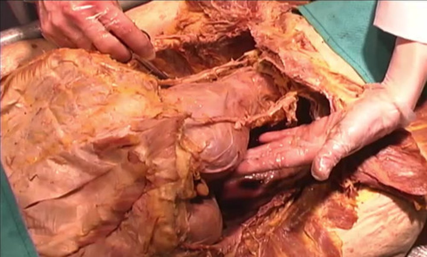<p>What name is given to this region of the thoracic cavity?</p><p>mediastinum</p><p>thoracic sac</p><p>thorax</p><p>pleural sac</p>