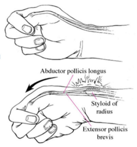 <p><span style="font-family: Calibri, sans-serif">De Quervain’s Tenosynovitis&nbsp;</span></p><ul><li><p><span style="font-family: Calibri, sans-serif">Maneuver designed to elicit pain from the 1st dorsal compartment</span></p></li></ul><p></p>