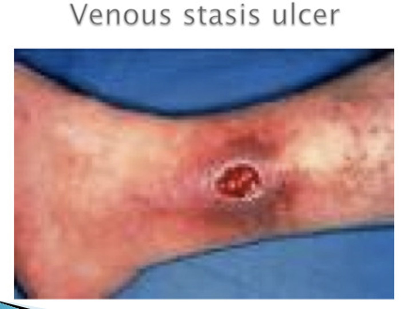 <p><b>Secondary</b> <br><br>a deeper loss of epidermis and dermis; may bleed or scar <br><br>example: stasis ulcer of venous insufficiency</p>