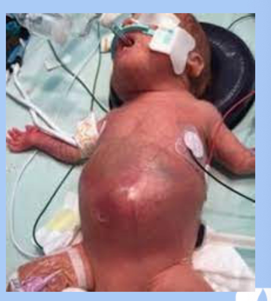 <p>-most common acquired GI emergency</p><p>-cellular damage, cellular death, necrosis of colon and intestine</p><p>-sx: abdominal distension, heme + stool</p>