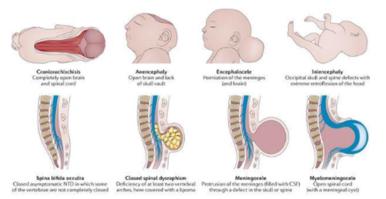 <p><strong><u>Folate deficiency in pregnancy</u></strong></p><ol><li><p>Periconceptional folic acid supplementation recommended to DECREASE the occurrence of __________ </p></li><li><p>^ occurs during _____ of life</p></li></ol><p></p>