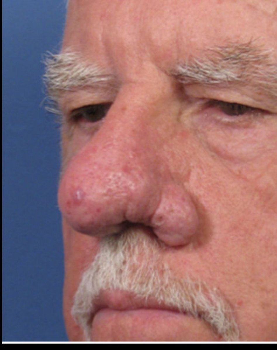 <p>1)Female<br>2) 30-50 years <br>3) Fair Skin<br>4)Genetic<br>5)Alcoholism (skin flushing)</p>