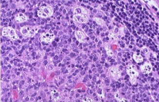 <p>Cell shrinkage and eosinophilia </p><p>chromatin condensation </p><p>formation of apoptotic bodies </p><p>phagocytosis of apoptotic bodies </p>